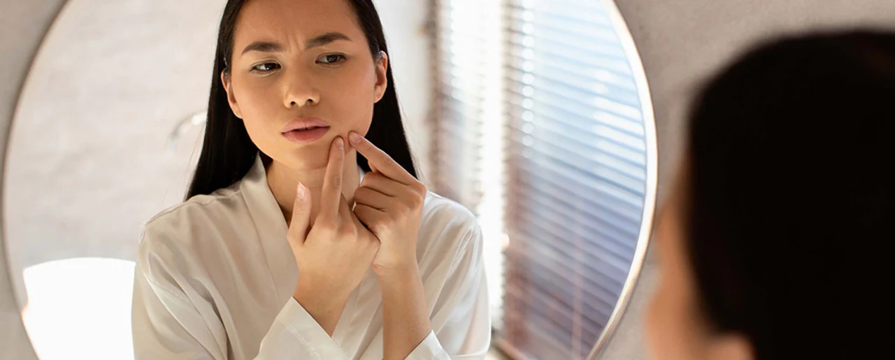 Kenali Acne Triggers, Ini Dia Penyebabnya yang Sering Diabaikan!