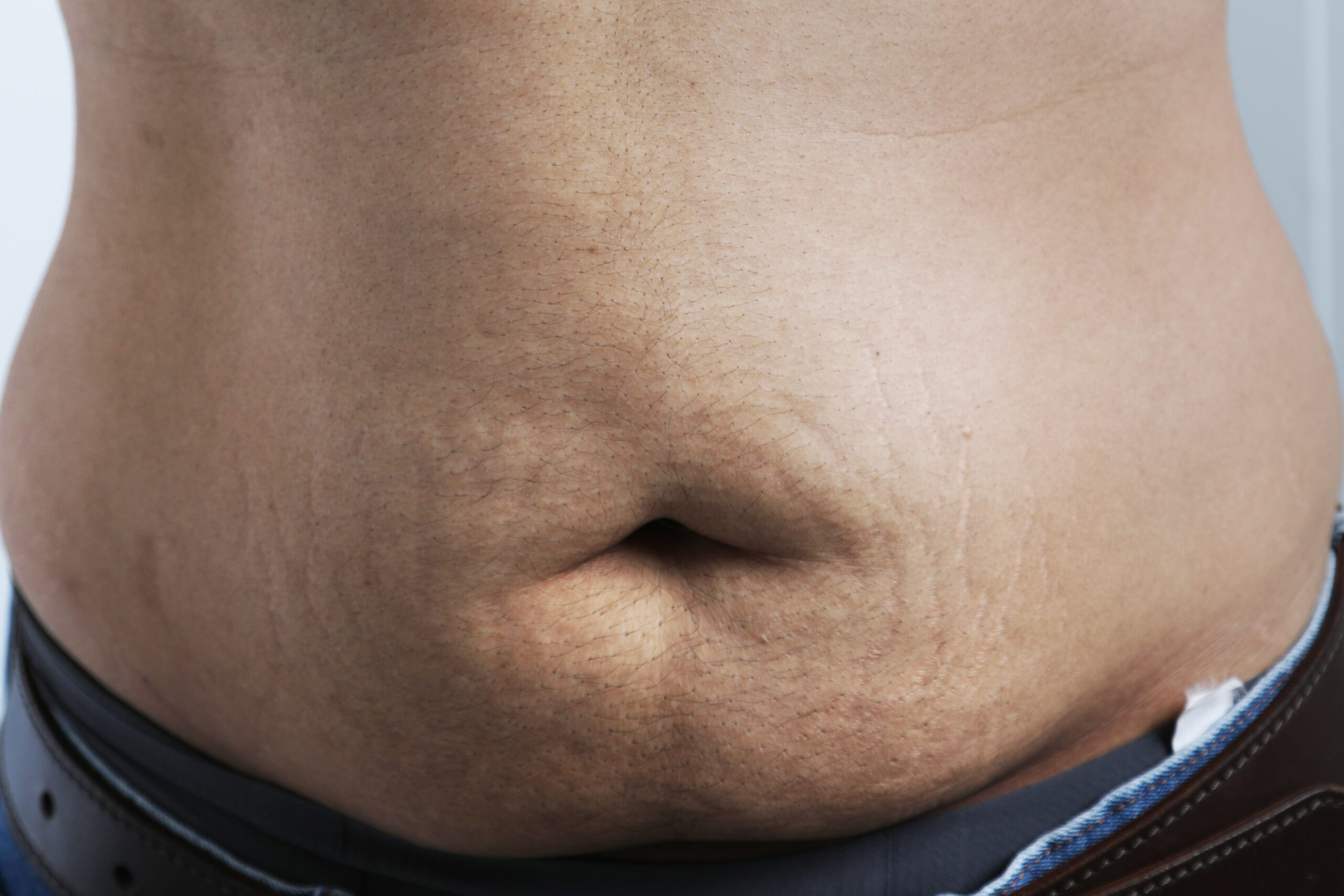 6 “Top Picks” Stretchmarks : What are my options? Pros/Cons? and How painful are they?