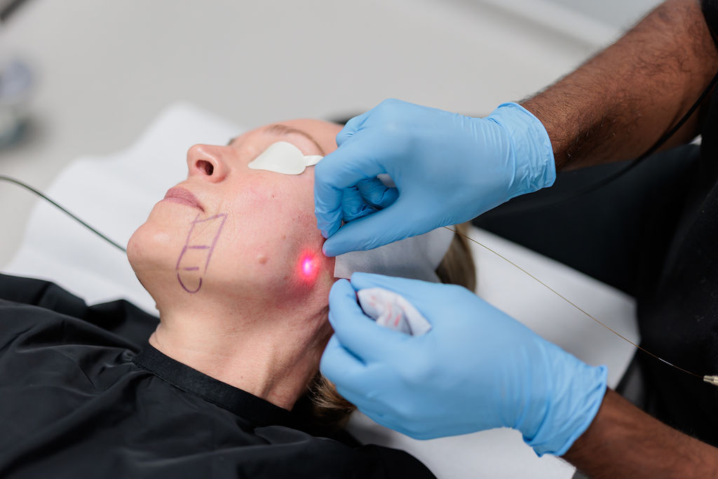 A Subtle Lift with Powerful Results — Meet Endolift