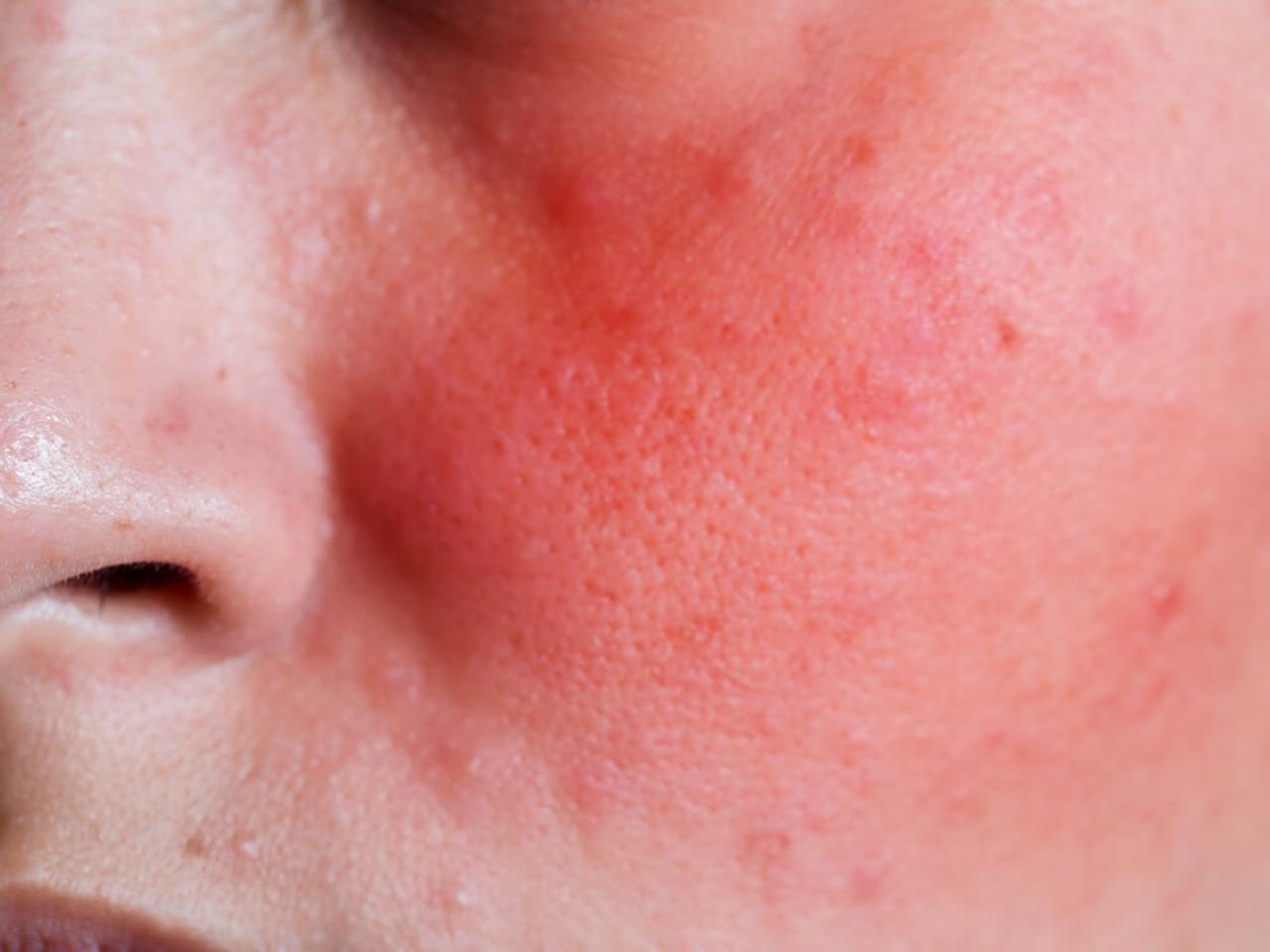 Jerawat di Usia Dewasa? Bisa Jadi Rosacea, Bukan Acne Biasa