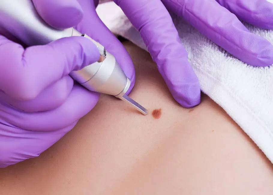 Bedah Tahi Lalat di Jakarta: Mole Excision, Novus, dan Biopsy