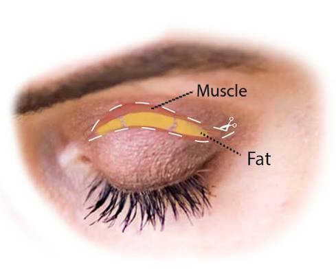 Operasi Kelopak Mata Atas dengan Upper Eye Blepharoplasty