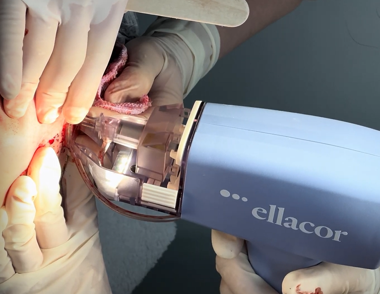 Pore Surgery Ellacor di Jakarta: Cara Kerja & Aftercare