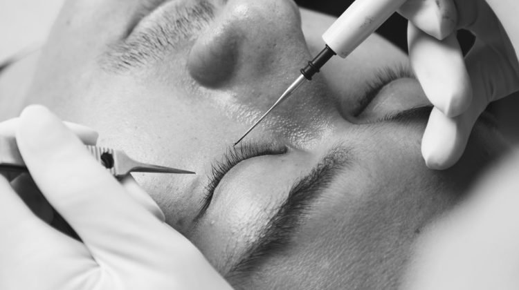 MS WEBSITE_BW_Blepharoplasty_5 (1)